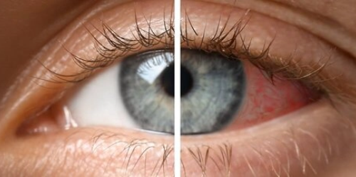 Clear eye comparison with inflamed eye
